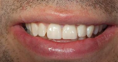 A BruxZir solid zirconia veneer case