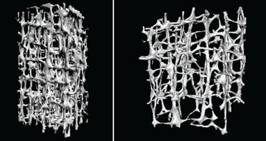 Osteoporosi e bisfosfonati