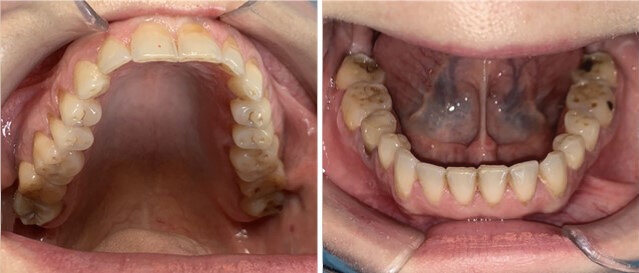 Fig. 2a_Visione occlusale: immagini cliniche e (b) file .STL. 