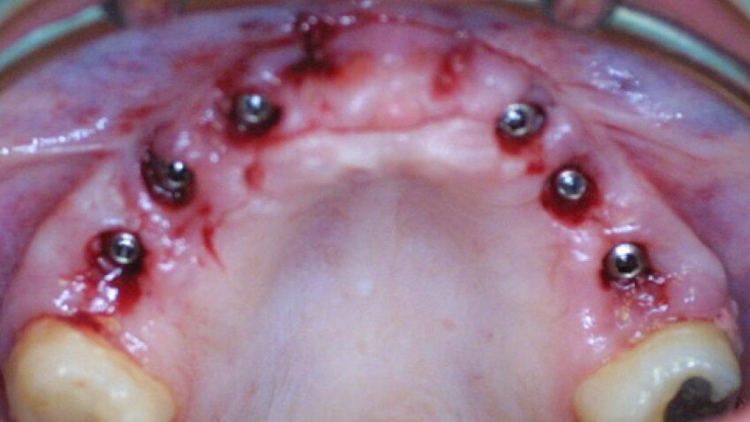 Planification prothétique rapide et facile