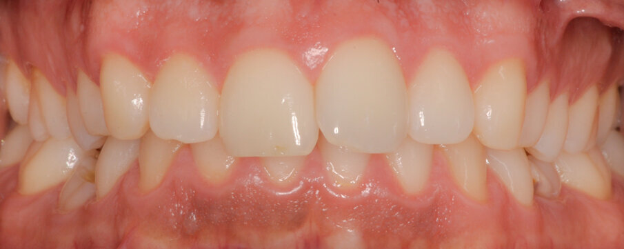 Fig. 1_In evidenza la persistenza dei decidui in quadrante 3-4.