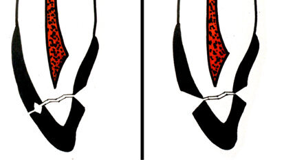 Traumatologia dentale in età pediatrica