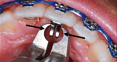 BiTurbo2 (BT2) systém pro rychlou úpravu hlubokého skusu