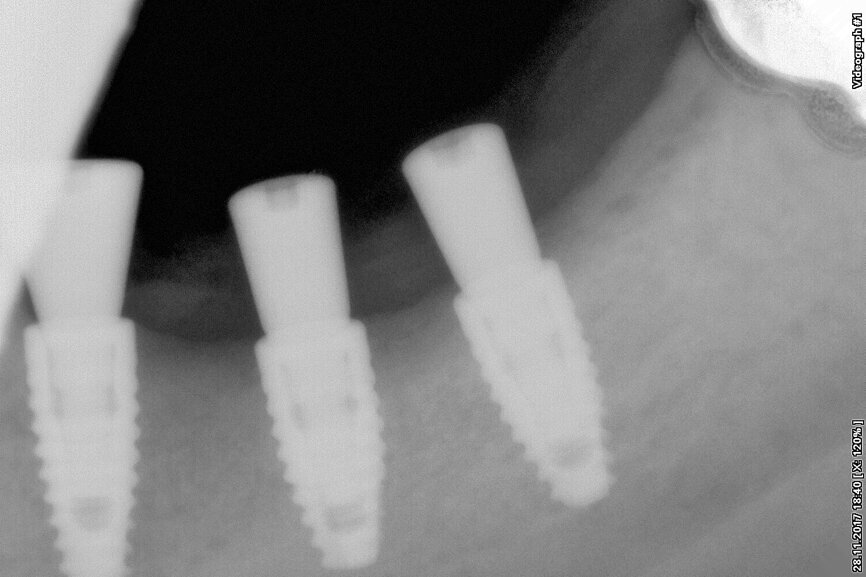Fig. 6: Detail of new bone formation.