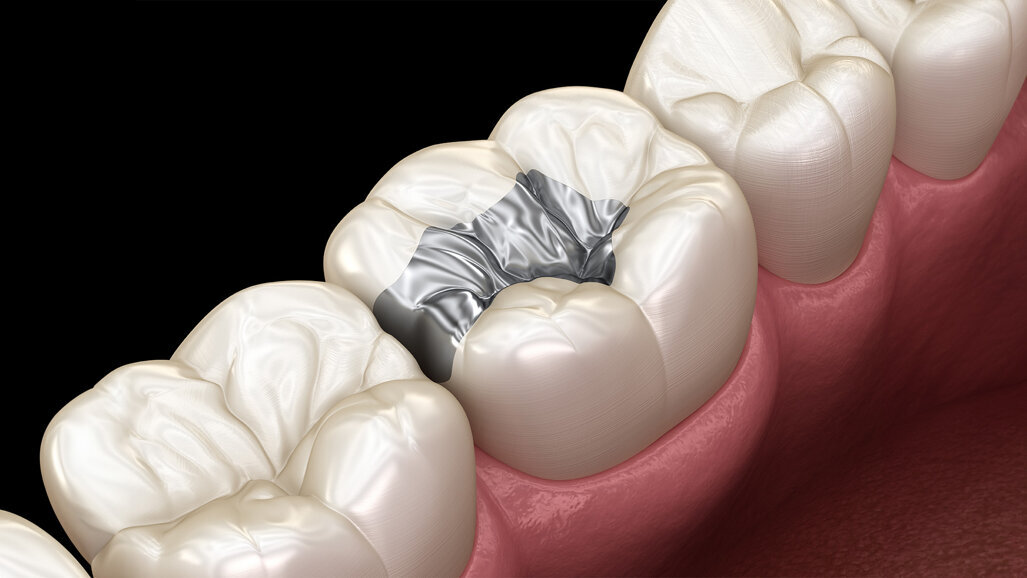 Amalgam-Verbot ab 2025: Was Sie wissen sollten