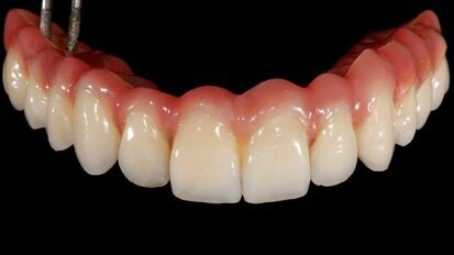 Full-arch reconstruction of the edentulous maxilla with the CAMLOG Guide System