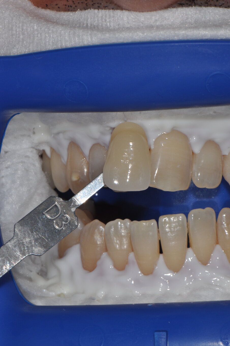 Fig. 8 - Rilevamento del colore a tempo zero utilizzando la scala “Vita” D3.