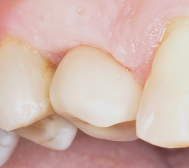 Fig.11: Case 1. Healing at 12 months after MAINST therapy.