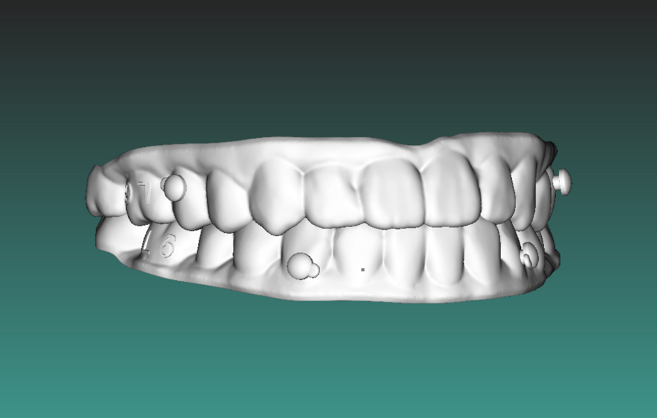 Fig. 10b: Buttons on the aligners for Class III elastic.