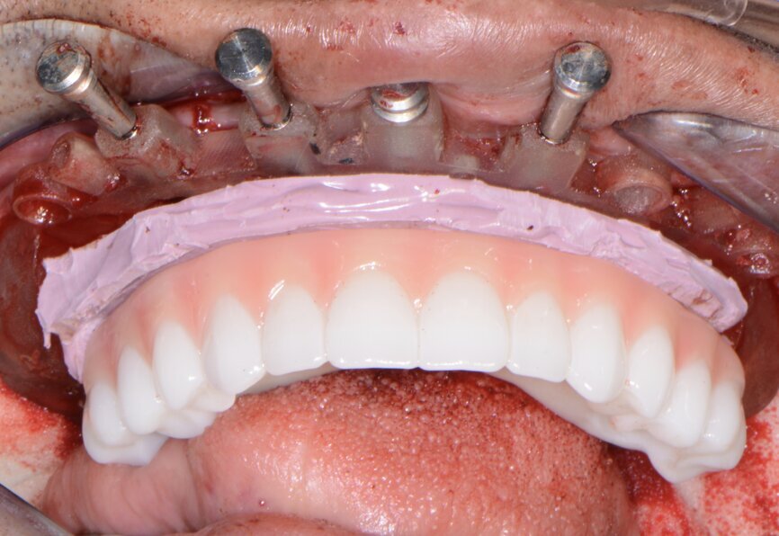 Fig. 15: Insertion of provisional restoration.