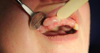 Duże wyrośle kostne szczęki – opis przypadku