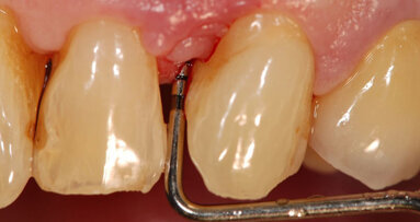 Rigenerazione parodontale  in zona estetica