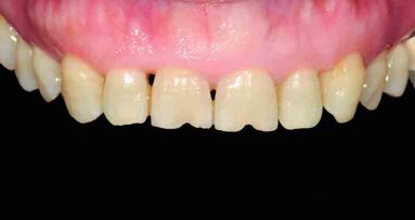 Chairside CAD/CAM immediate restorations