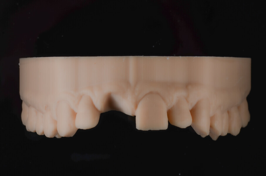 Fig. 5a: Models after virtual extraction 3D-printed from Asiga DentaMODEL using the MAX UV, anterior view.