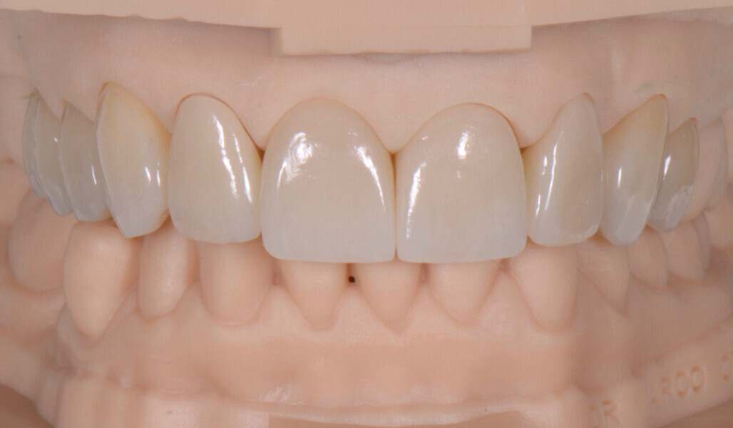Fig. 16: Frontal view of the denitive restorations.