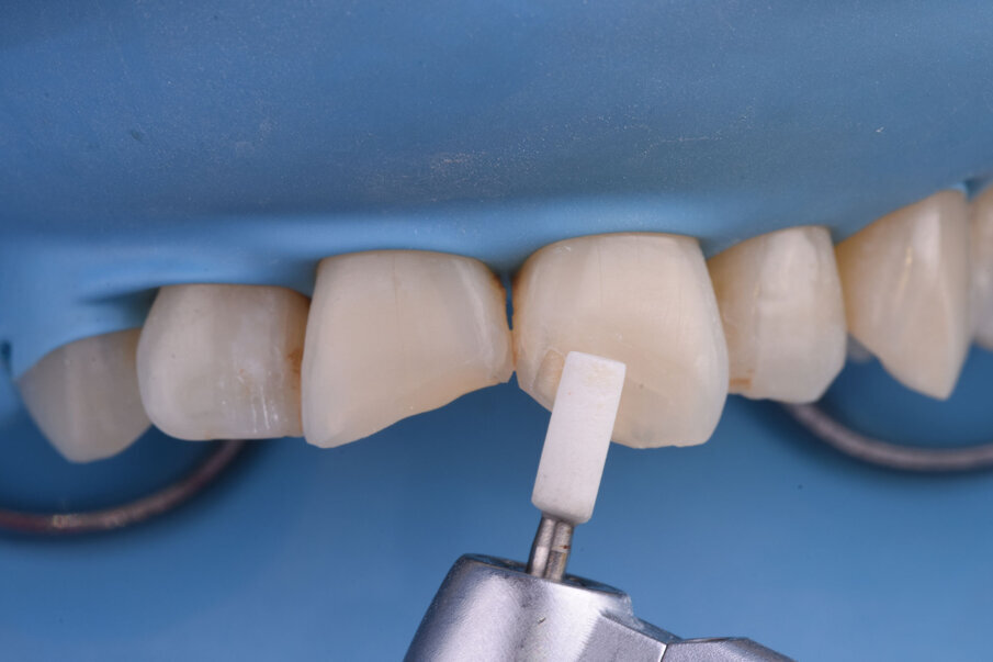 Sl. 6b: Preparacija zuba, zakošavanje preparacije  sa vestibularne strane (6b). 