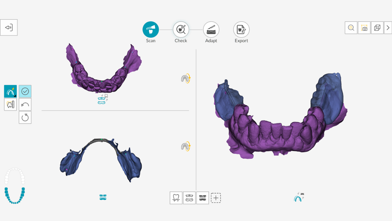 Denture matching in DEXIS IS ScanFlow.