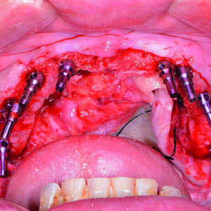 Fig-10-Tenons-parallèles-mis-en-place-300x300-