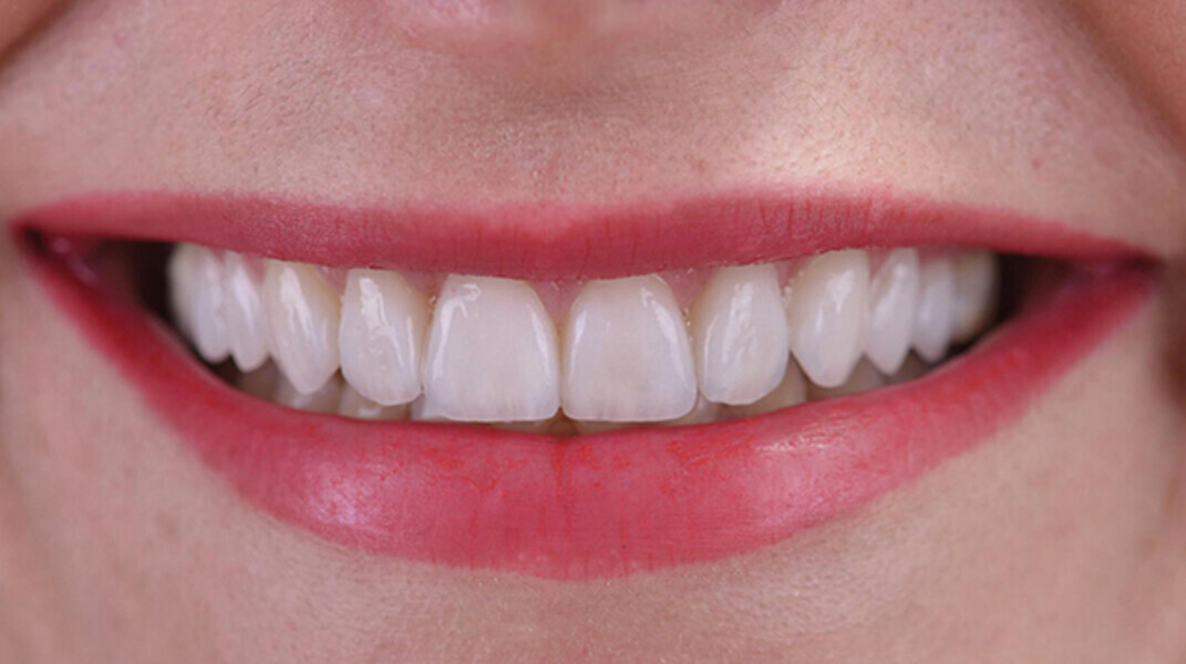 Fig. 17d. Amplia sonrisa.