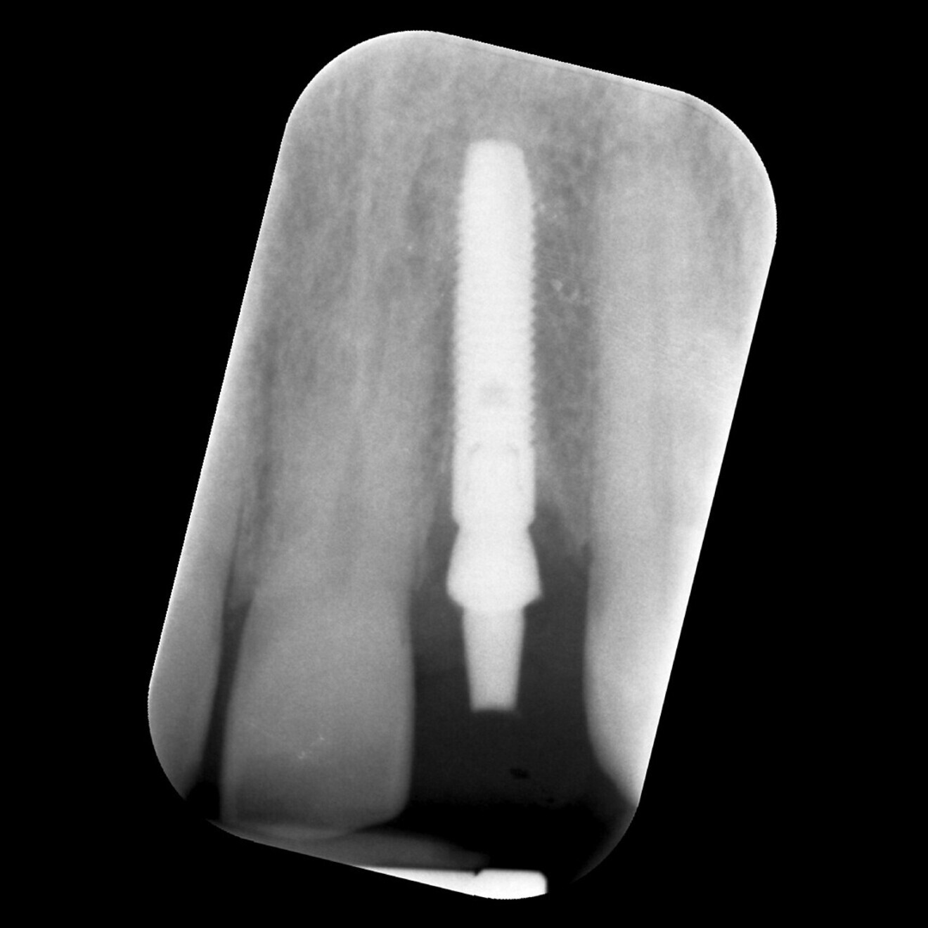 Fig. 16: Baseline radiograph of the implant mapped in Figure 15, showing good marginal bone levels.