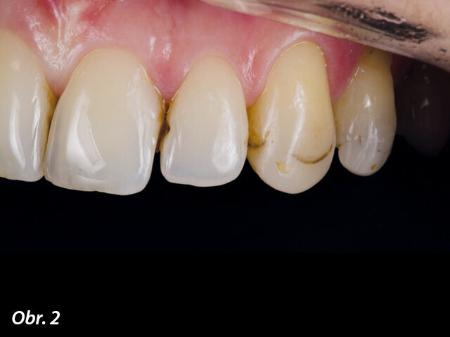 Obr. 1, 2: Původní situace: zuby 22 a 23 vyžadují ošetření.
