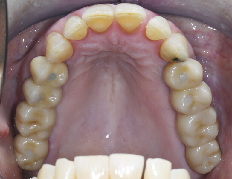 Fig. 18: Final restoration.