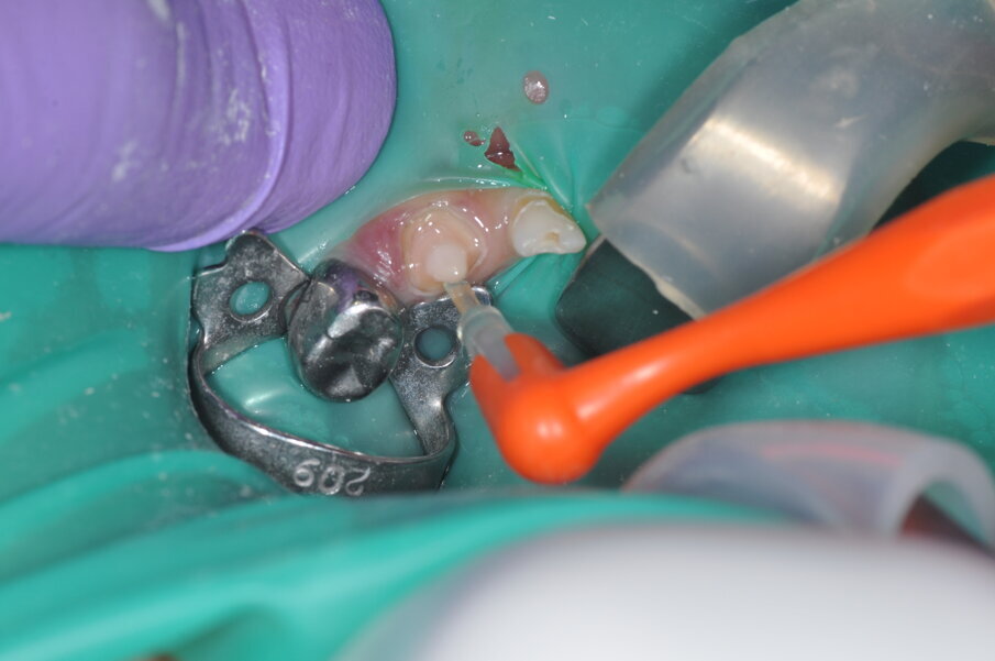 Fig. 7: Bonding agent applied and light cured for 20 seconds.