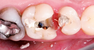 Indikační šíře MTA: Soubor kazuistik