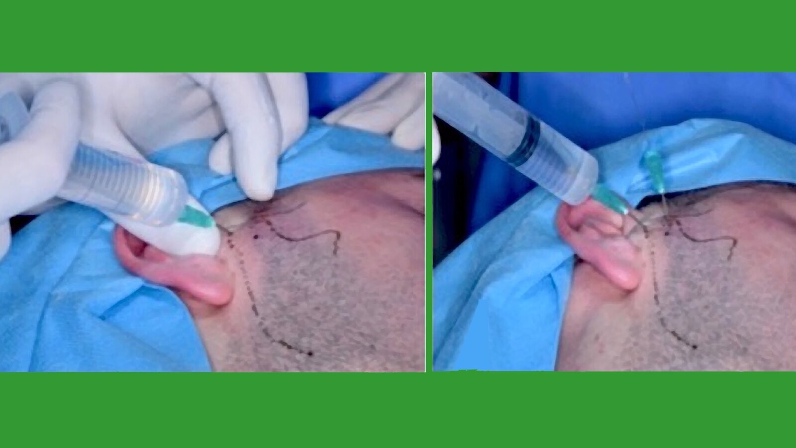 Tratamiento quirúrgico mínimamente invasivo de la ATM (2)