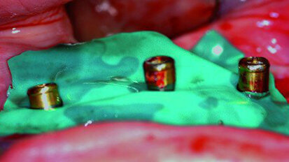 The use of existing locators to stabilize a CBCT-software derived surgical guide - Conversion of a mandibular removable to a fixed prosthesis