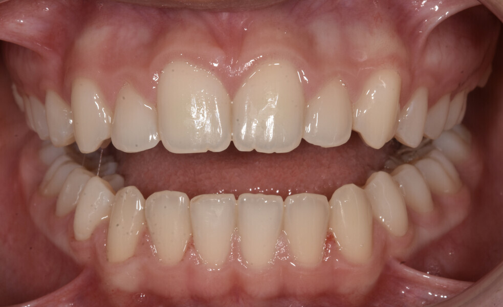Fig. 5: Facial and intra-oral photographs after treatment with fixed orthodontic appliances.