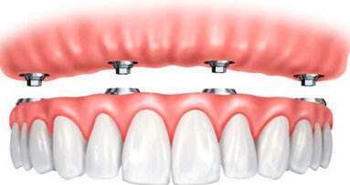 Il mercato dell Overdenture in Francia è tra i più redditizi d’Europa