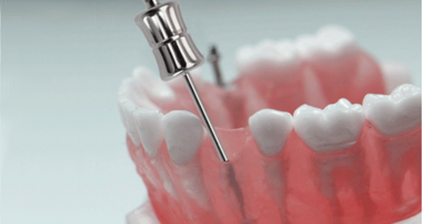 Nuevos extractores manuales para fragmentos de raíces