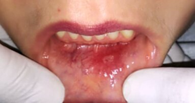 Tratamiento de afta bucal con ozonoterapia