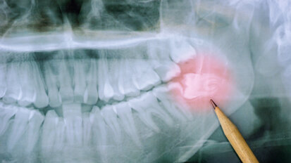 Aktualisierte S2k-Leitlinie zur Weisheitszahnentfernung Aktualisierte S2k-Leitlinie zur Weisheitszahnentfernung