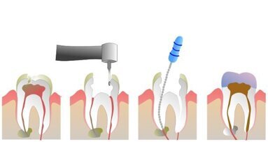 Novi endodontski tretman koji će zameniti klasičnu endodonciju