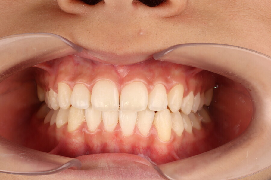 Figs. 11–15: Clinical situation mid-treatment. Improved midline and improved alignment, but occlusion still unsettled.