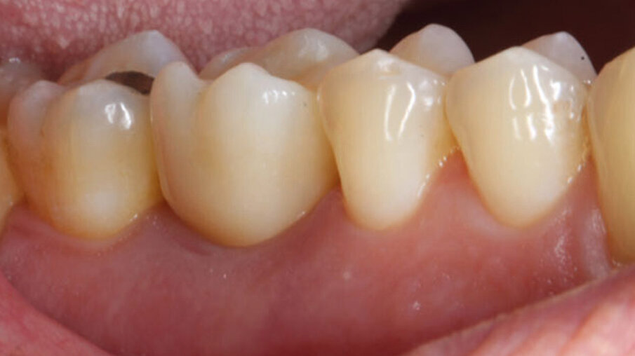 Fig. 11_Foto controllo (vista vestibolare) a 2 anni.