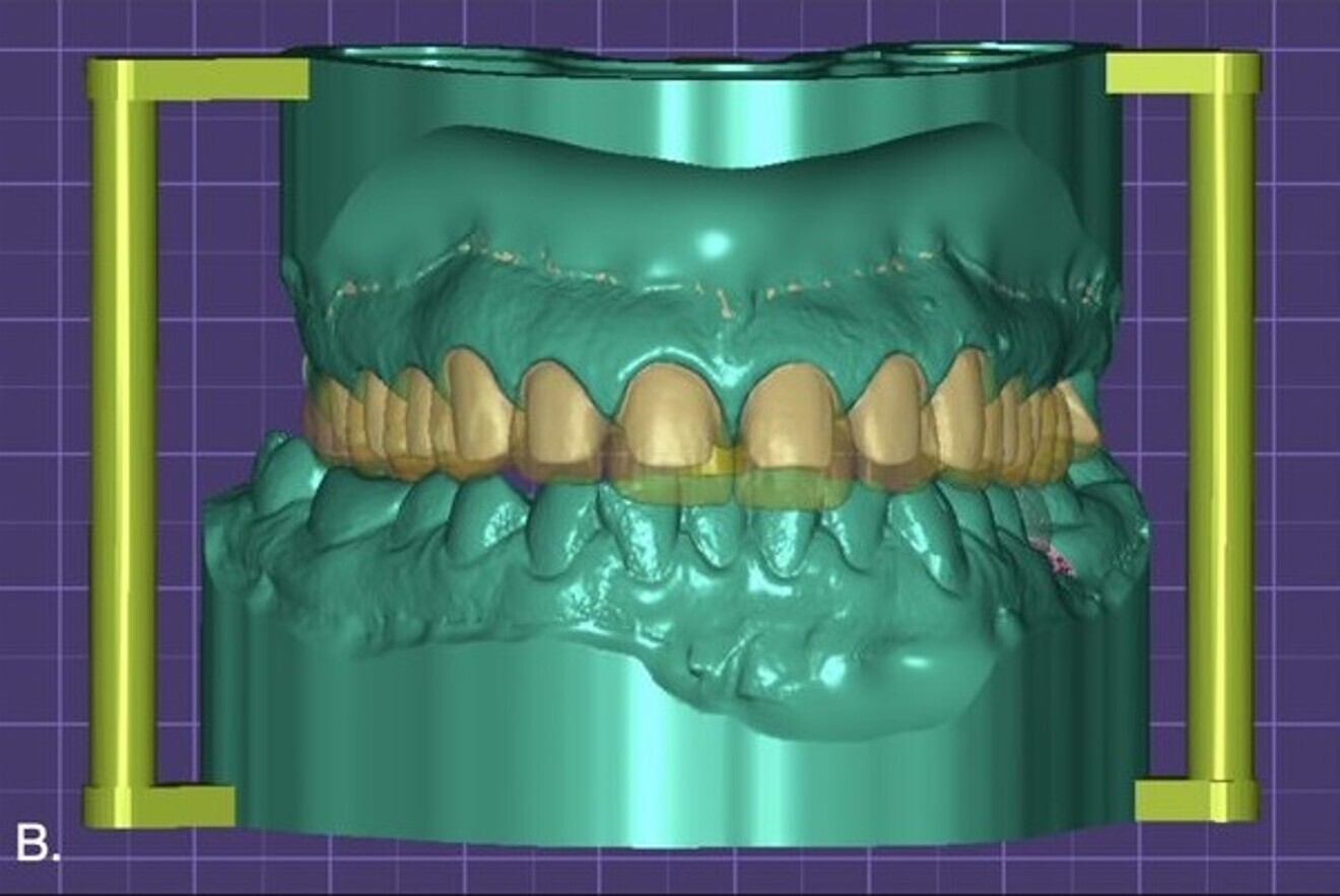 Fig. 5b: Merging of the mock-up with the preparations for the final restorations. 