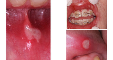 Aftas bucales. ¿Hay algo nuevo?