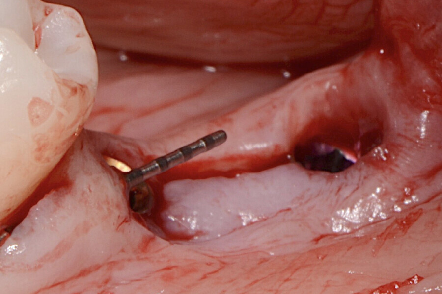 Fig. 10 : Essai de greffe gingivale par lambeau pédiculé.