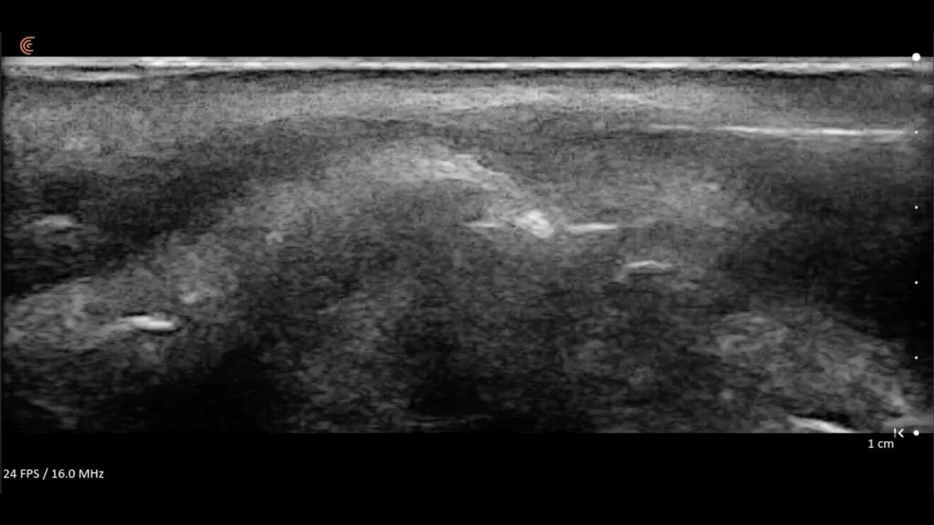 Fig.7 - Iniezione ecoguidata di ialuronidasi in un bolo di filler a base di acido ialuronico. 