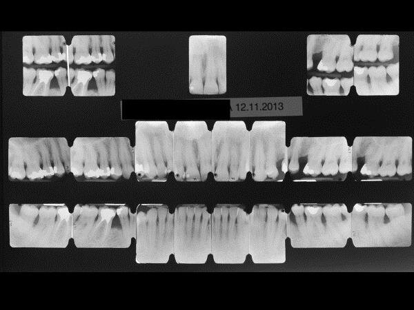 Fig. 1b - Status radiografico completo  eseguito dopo la prima visita, che conferma l’allora diagnosi di malattia parodontale in forma moderata [10] per la presenza di lesioni ossee soprattutto nei settori posteriori e generalizzata, in quanto più del 30% dei siti risultano coinvolti.