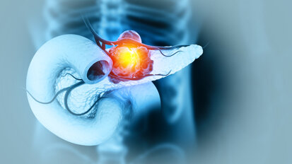 Natural tooth count associated with long-term survival after pancreatic cancer surgery