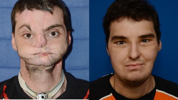 Gezichtstransplantaties veilig en succesvol