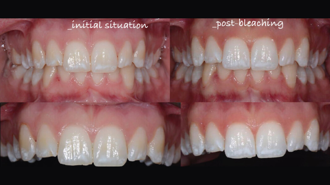 Fig. 15 - Confronto prima e dopo il trattamento con BlancOne Ever. 