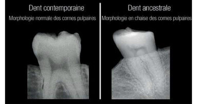 Selon une nouvelle étude, les radiographies dentaires peuvent révéler une carence en vitamine D