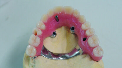 Implantologie basale, activation ostéogénique, mise en charge immédiate : clinique / « dogmes »