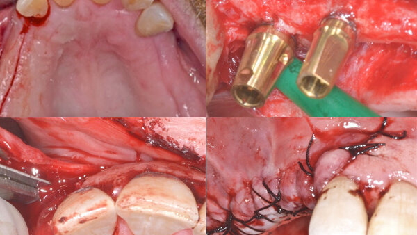 Tratamiento de defectos óseos con biomateriales y técnicas de barrera