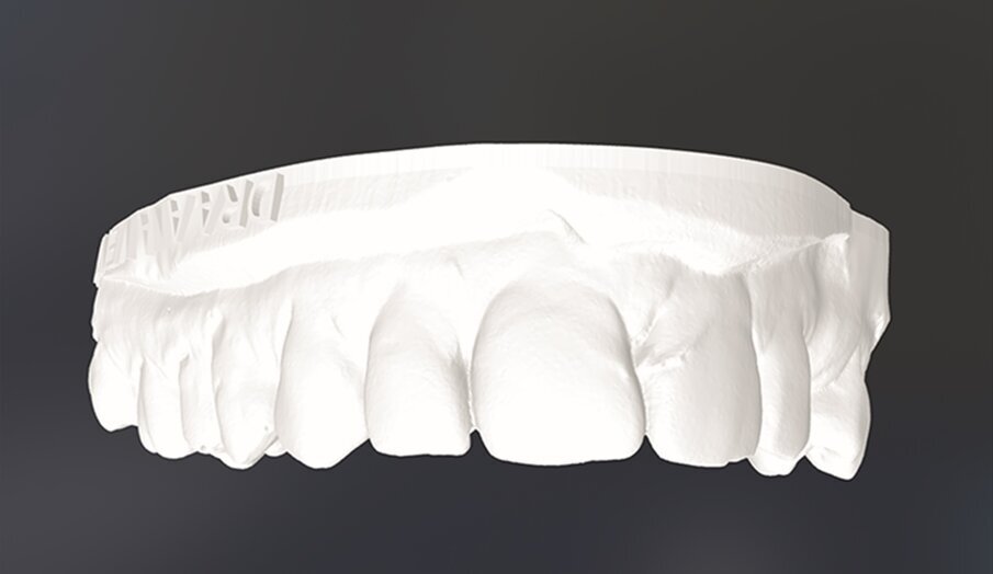 Fig. 2d: STL file obtained from the intra-oral scan.